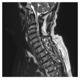 척수병증을 동반한 경추부 척추관 협착증을 보이는 환자의 경추 자기 공명 영상 사진