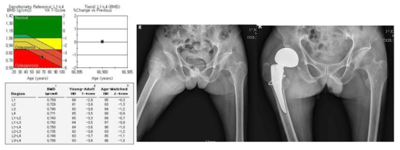 골다공증으로 인하여 낙상 후 우측 고관절 골절이 발생한 환자의 DEXA 결과 및 고관절 치환 수술 전후 단순방사선 사진