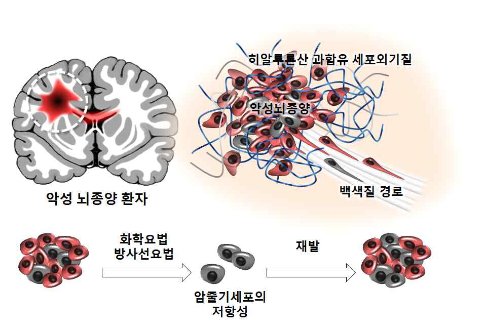 악성 뇌종양 환자의 미세환경과 암줄기 세포의 치료 저항성