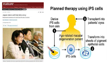 유도만능줄기세포를 이용한 첫 임상연구