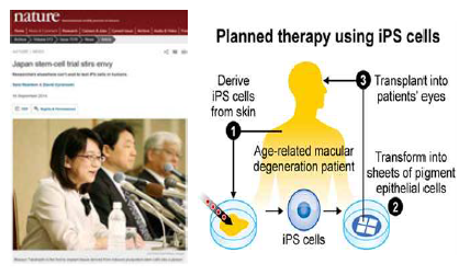유도만능줄기세포를 이용한 첫 임상연구