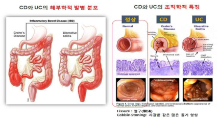 크론병(Crohn’s disease, CD)와 궤양성 대장염 (ulcerative colitis, UC)의 해부학적 발병 분포 및 조직학적 특징