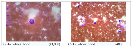 Peripheral Blood Smear & Diff-Quik staining 을 통한 환자 혈액내의 탐식된 A. phagocytophilum 을 확인