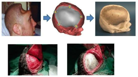 3D 프린팅 기술을 이용한 인공 머리뼈 제작 및 수술 과정