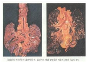 정상인의 폐(좌)와 흡연자의 폐(우) 비교