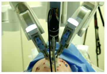 단일 통로를 이용한 소장 절제술 시행중 정면에서 바라본 모습(로봇암 사이의 접촉 없이 10도 미만의 최소 각도로 수술 시행)