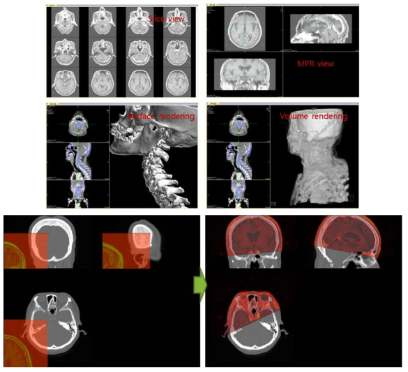 의료영상 데이터를 이용한 4가지 Display mode 개발, CT-MRI 정합 결과