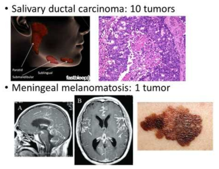 RNA seq을 수행한 샘플 모습. 10개의 salivary ductal carcinoma와 1개의 1개의 meningeal melanomatosis의 샘플을 제공받아 RNA seq을 수행하였음