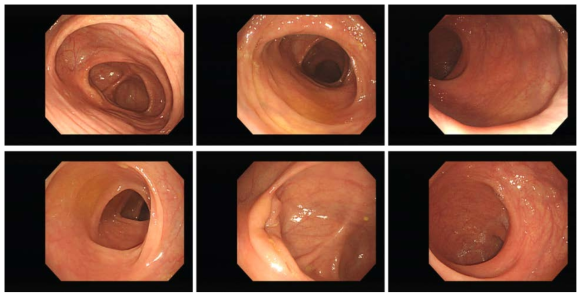 대장 내시경 관찰