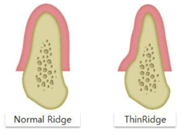 골폭에 따른 치조골의 형태 (좌)일반적인 형태의 치조골, (우)좁은폭 형태의 치조골