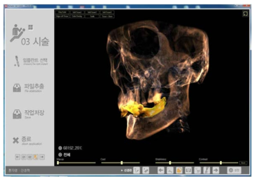 치과용 CBCT에서 획득한 dicom파일에 치과용 디지털 스캐너를 이용하여 환자 구강에서 채득한 인상을 제작하여 제작된 구강모형을 스캔 후 얻은 3D STL 파일을 프로그램상에 로딩하여, 두 이미지를 병합한 모습