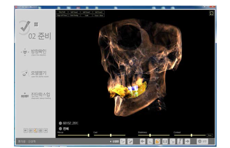 CT의 골정보와, 모형상의 인접치아 및 치은의 형상, 완성될 최종보철물의 형태등 임플란트 진단을 위한 모든 정보가 집약된 3D 이미지상에서 결정된 임플란트의 위치