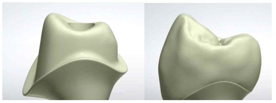 치과용 CAD에서 맞춤형 지대주 및 최종 보철물을 디자인