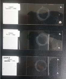 OVCAR3, YCC-33, SKOV3 세포주를 DAPI, EpCAM, CD45로 염색한 slide