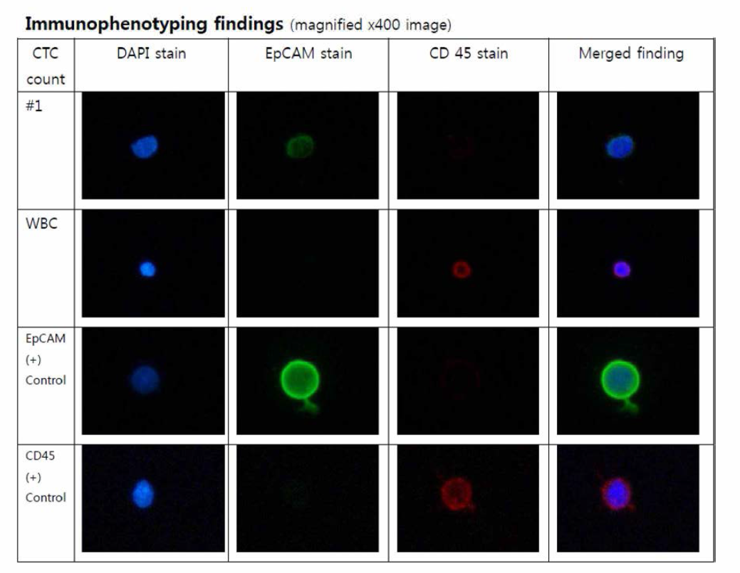 췌장암 환자 CTC 분석 후 DAPI, EpCAM, CD45 염색하여 현미경으로 관찰한 이미지