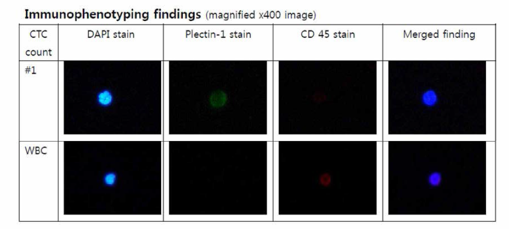 췌장암 환자 CTC 분석 후 DAPI, CD45, Plectin-1 으로 염색하여 관찰한 결과
