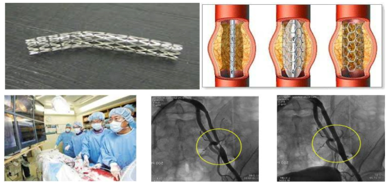 관상동맥 스텐트 삽입