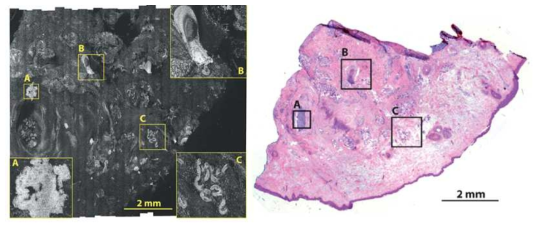 적출 조직의 대면적 공초점 현미경 영상(左)과 조직검사 H&E 슬라이드 영상(右) 비교