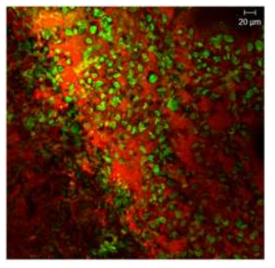 Calu-3 폐암 세포를 이용한 종양 조직의 형광 영상. Hoechst 33342로 염색된 핵은 green으로, Eosin Y로 염색된 세포질은 red로 표시