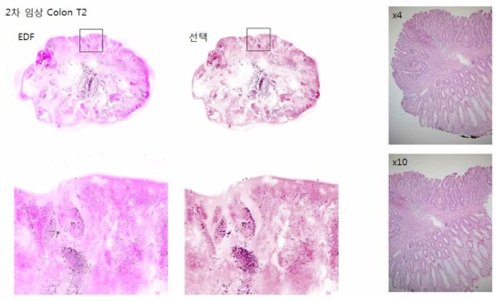 2차 Colon Tumor2 개발 장비(左, 中) 이미지 및 광학현미경 이미지(右)