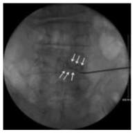 PTA catheter를 RK epidural needle을 통하여 foraminal space에 삽입