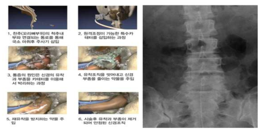 경피적 경막외 신경성형술