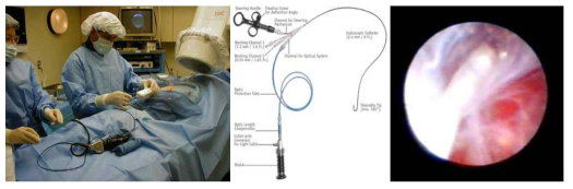 천추공 접근 경막외 내시경 레이저 감압술