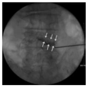 Dye injection을 시행 후 filling defect를 통해 pathology 확인