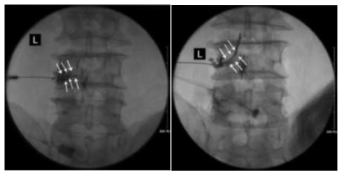 Decompression 후 filling defect 사라진 것을 확인하여 LFSS 병변에 대한 충분한 감압을 확인