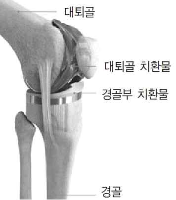 인공 무릎 관절 요소