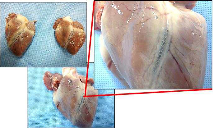 돼지 심장 혈관에 제작한 스텐트가 이식된 사진