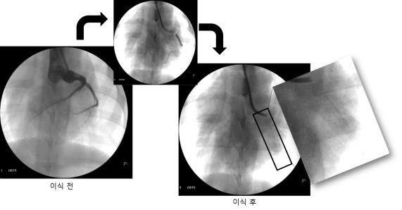 돼지 심장의 혈관조용술 결과