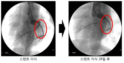 돼지 심장혈관에 스텐트를 28일 이식 후 조영술적 평가결과