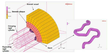 CoCr 합금 스텐트와 혈관의 내구 해석 모델