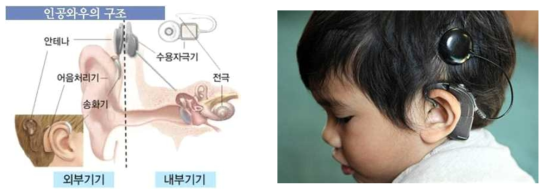 인공와우 (Cochlea Implant)