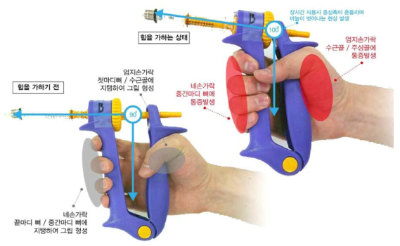 기존 연속주사기를 사용할 때 발생하는 관절부 통증