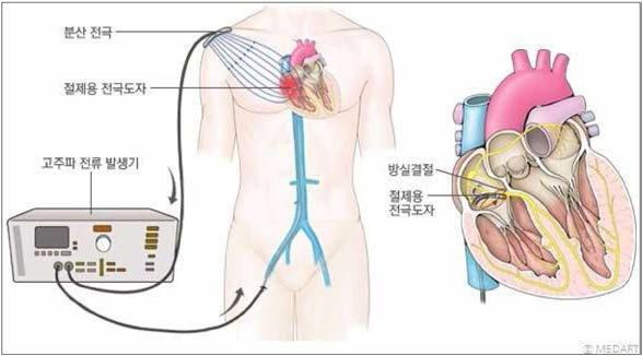 전극도자절제술 모식도