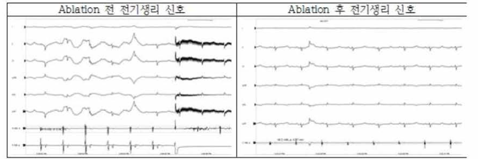 소작 전，후 ECG 신호