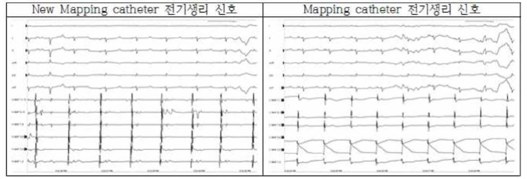 가변 원형 맵핑 카테터의 전기생리 신호