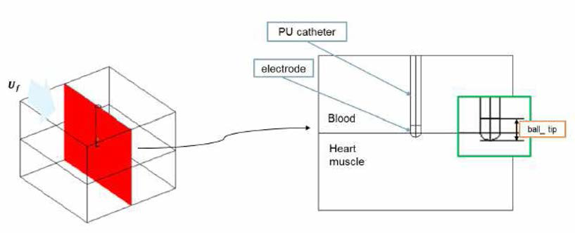 전극 카테터 및 심근 조직 해석 모델링