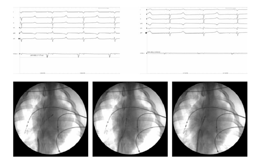 소작카테터 ECG 및 C-arm