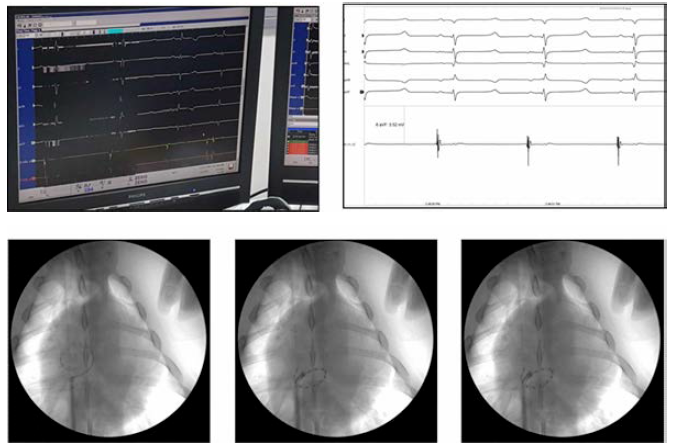 매핑카테터 ECG 및 C-arm