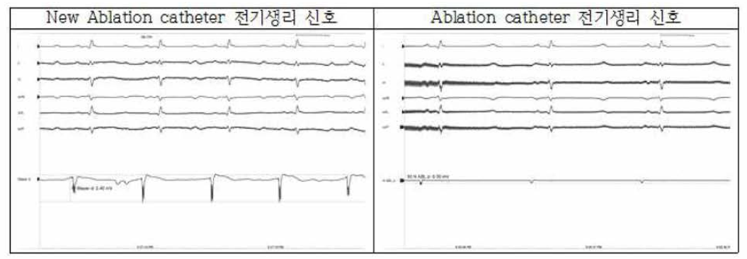 소작 전，후 ECG