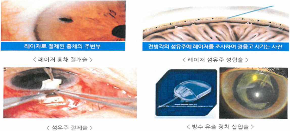 녹내장의 수술법