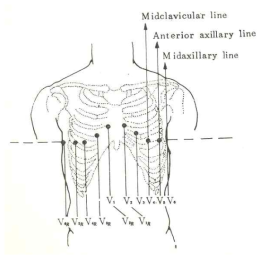 심전도 전극의 부착 위치