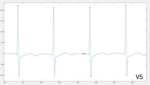 심전도 V5 전극의 파형 분석