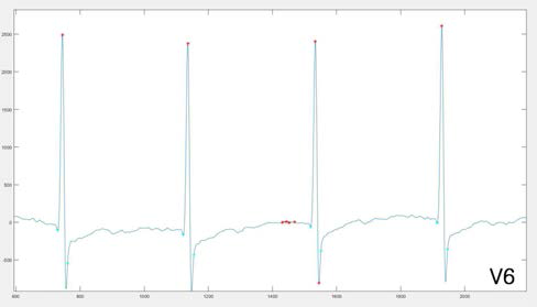 심전도 V6 전극의 파형 분석