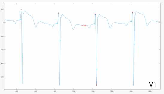 심전도 V1 전극의 파형 분석