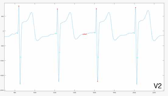 심전도 V2 전극의 파형 분석