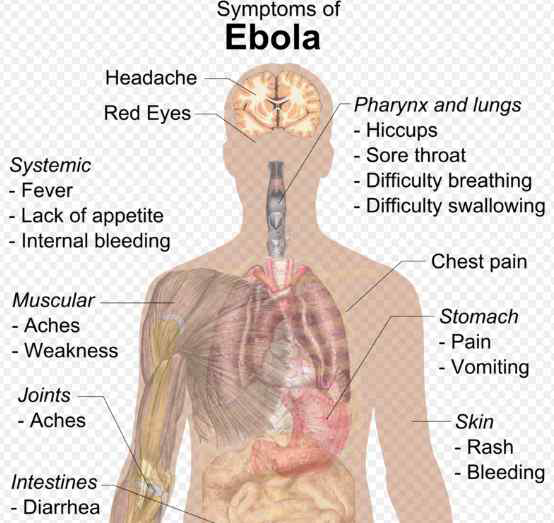 에볼라 증상